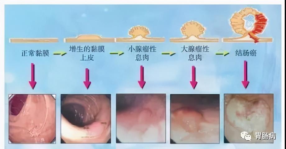 惊！兄妹7人竟有5人患肠癌，家族魔咒还是命运捉弄？